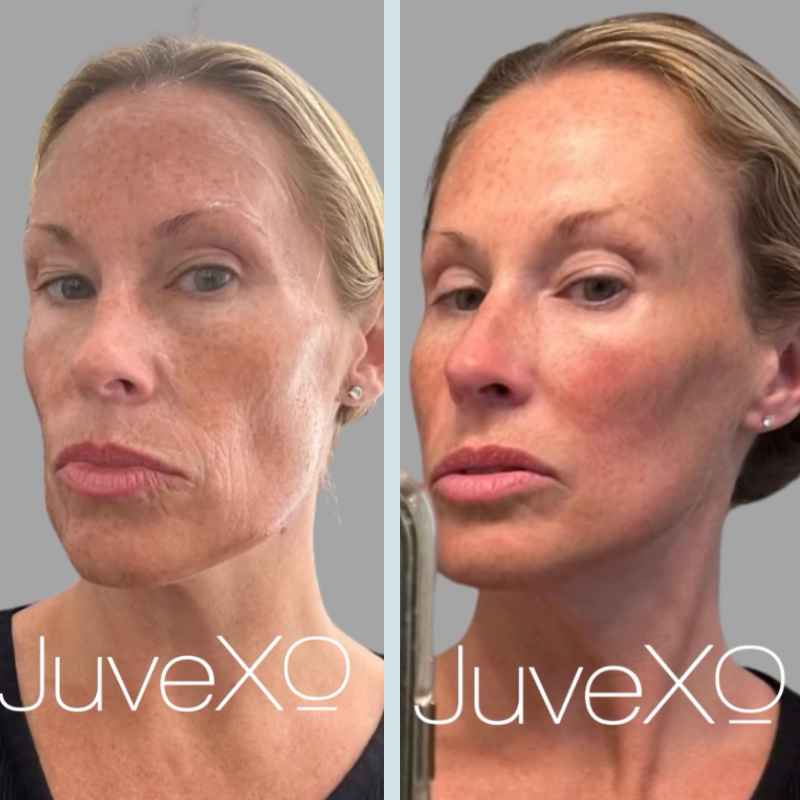 Enhancing Morpheus8 Treatments with JuveXO Exosomes