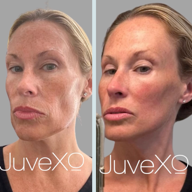 Enhancing Morpheus8 Treatments with JuveXO® Exosomes