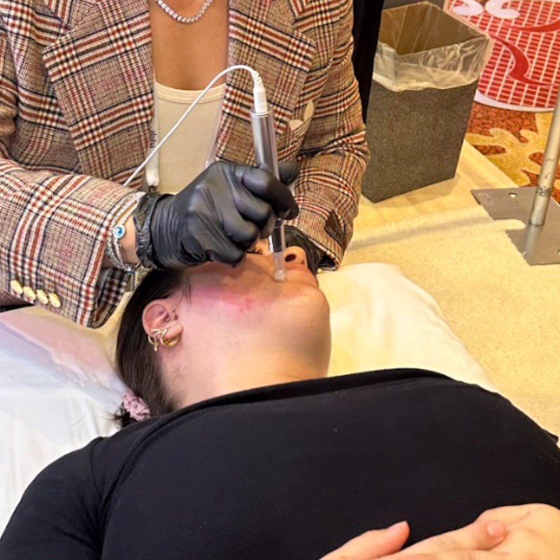 Microneedling Reinvented: JuveXO®'s XO Lift™